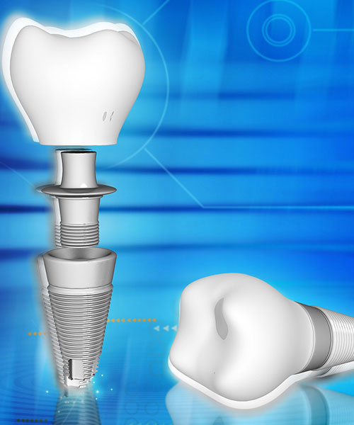 Nguyên tắc cần tuân thủ khi cấy răng Implant