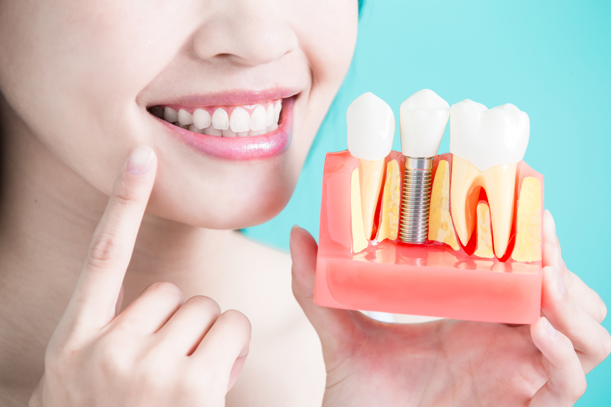 Thời gian nào để đặt Implant sau khi nhổ răng?