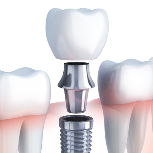 Trồng răng Implant mất bao lâu?