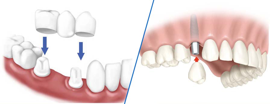 Nên trồng răng sứ hay phục hình răng Implant khi mất răng