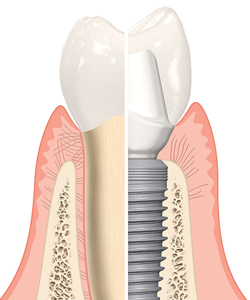 Tiêu xương hàm có thể cấy ghép implant được hay không?